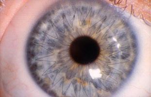 Closeup of a Blue Eye With a Star Formation on it After a Corneal Transplant