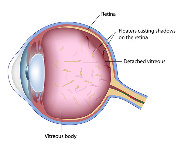 Chart Showing How Flashes and Floaters Affect the Eye