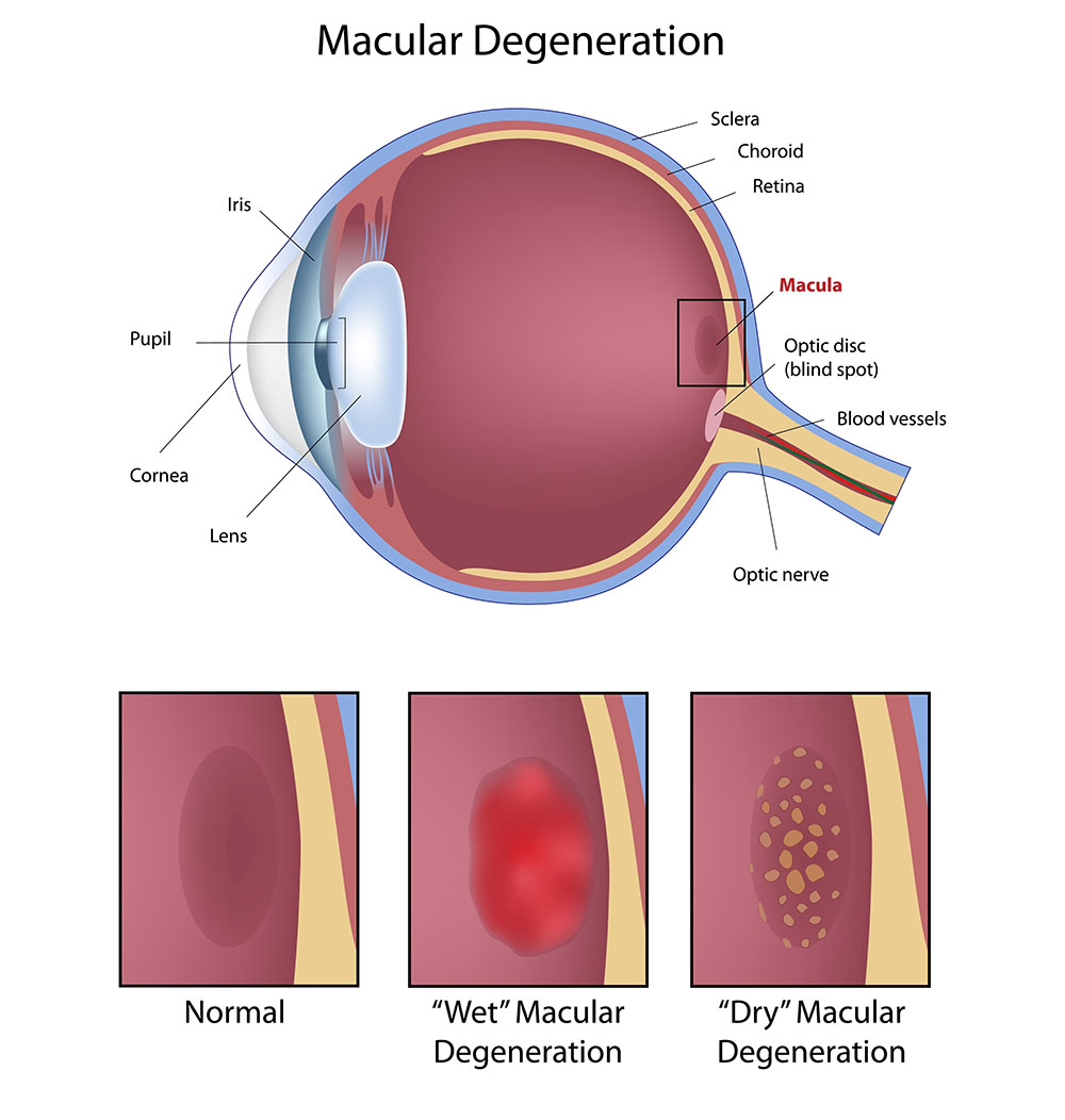 Chart Showing How Macular Degeneration Affects the Eye. Also Showing Normal, Wet Macular Degeneration and Dry Macular Degeneration
