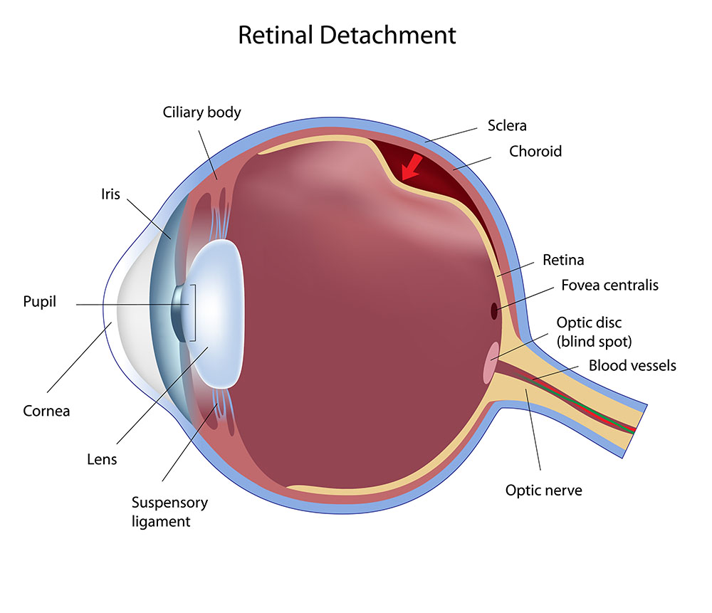 Chart Showing a Retinal Detachment